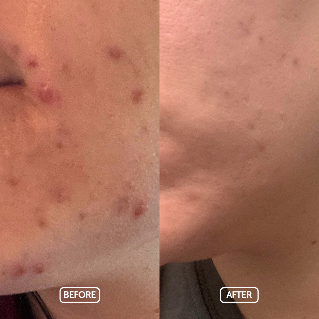 Before and after comparison of skin after use the clean skin system from cosmette