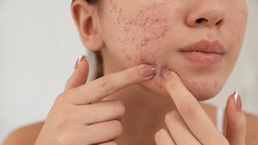 Signs of Irritation from Skincare