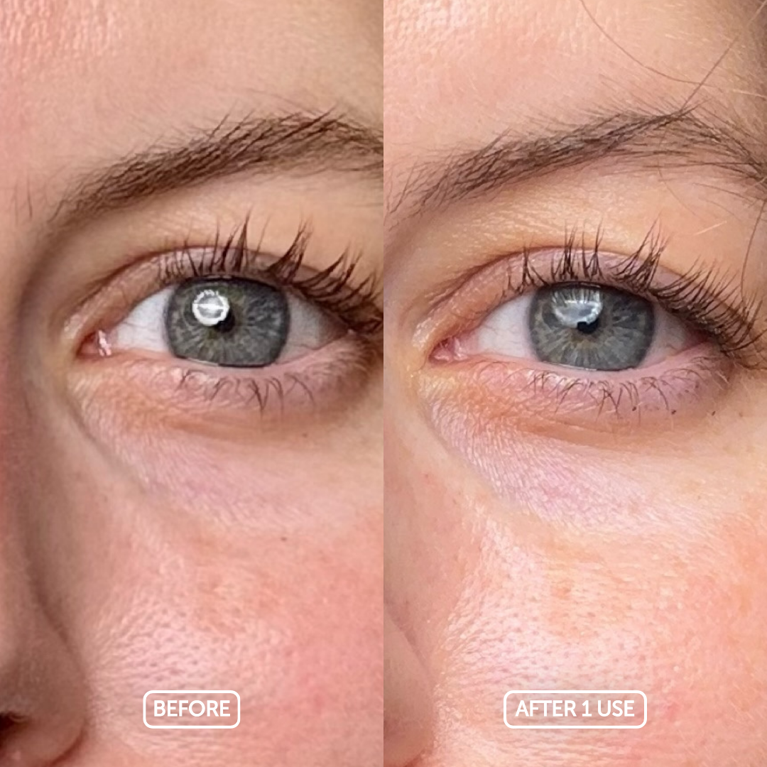Before and after comparison of eye area treatment showing improved skin texture.