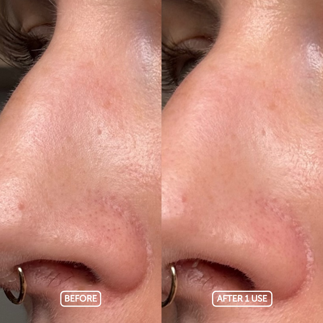 Before and after comparison of a nose with dreamy oil cleanser application.