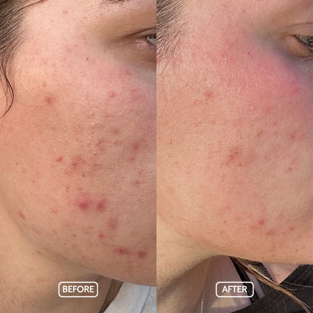 Before and after skin comparison of use Pure Clarity oil 