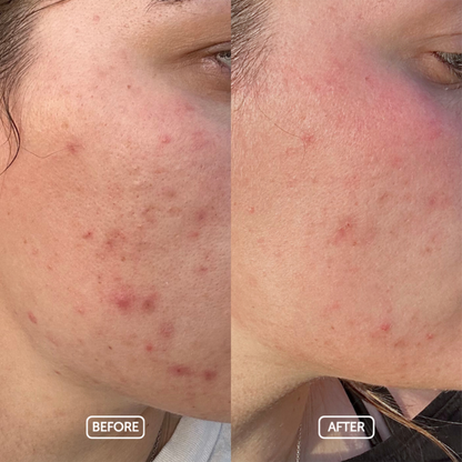 Before and after skin comparison of use Pure Clarity oil 