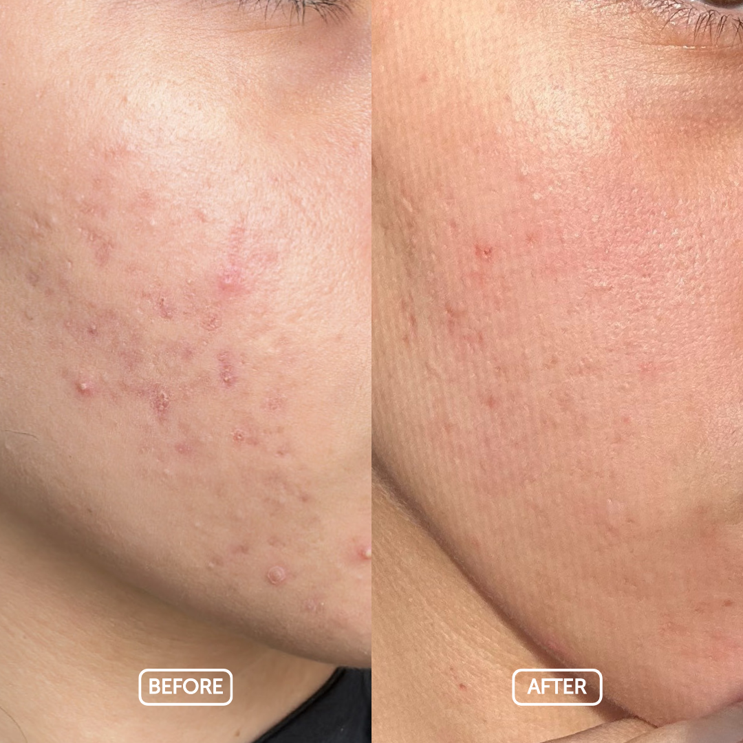 Before and after comparison of skin using cosmette products
