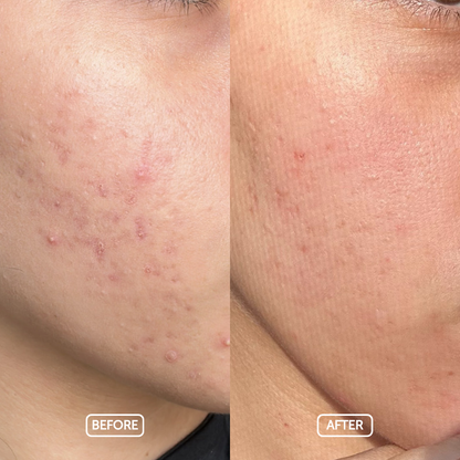 Before and after comparison of skin using cosmette products