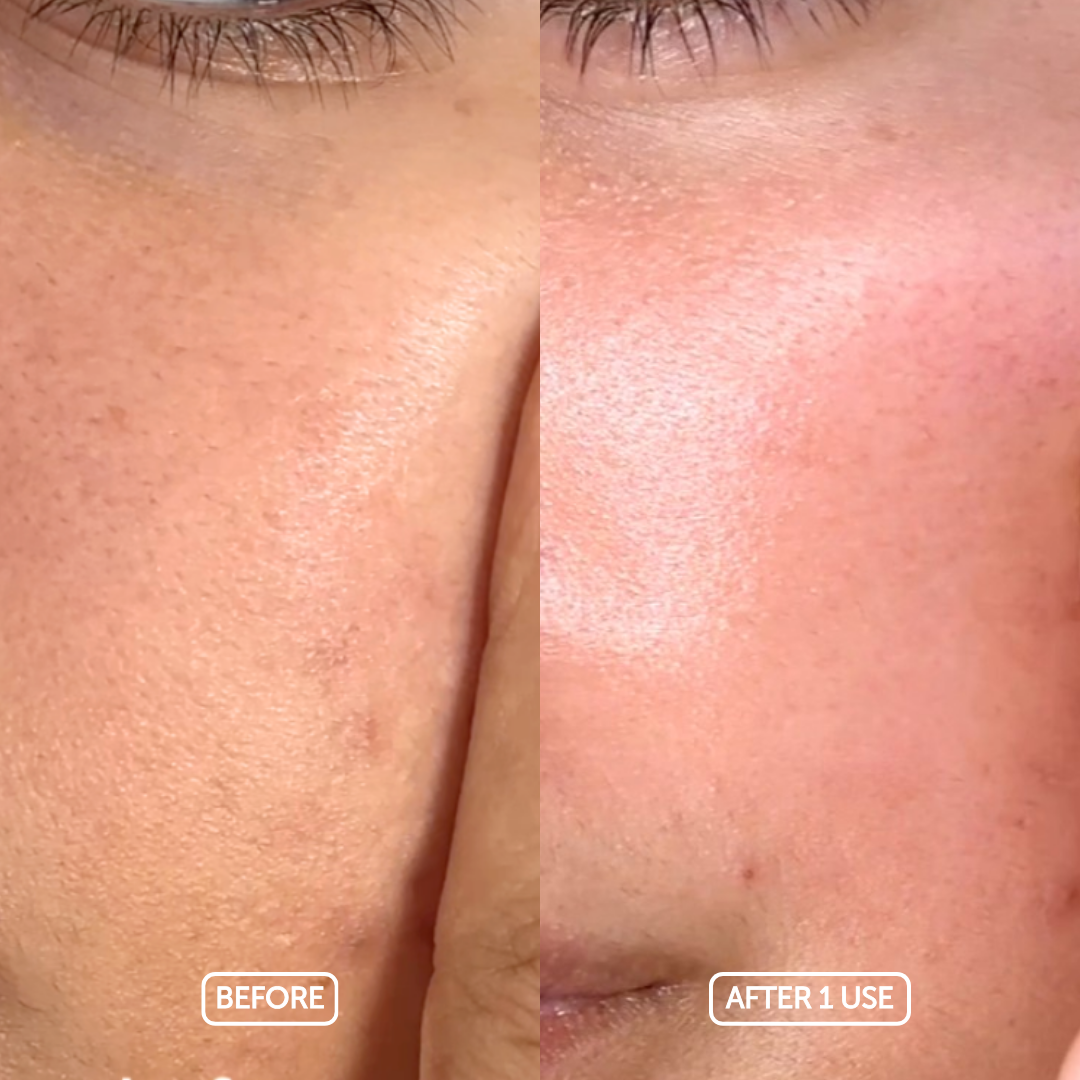 Before and after comparison of skin treatment on a person's face using cosmette skincare products
